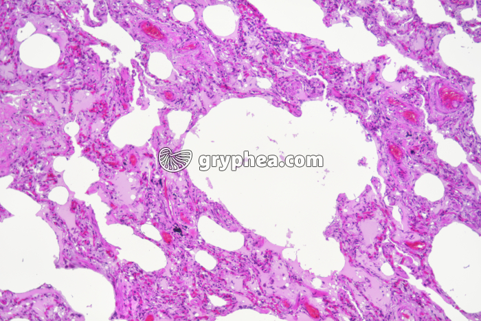 Poumon fumeur x25 - gryphea.org